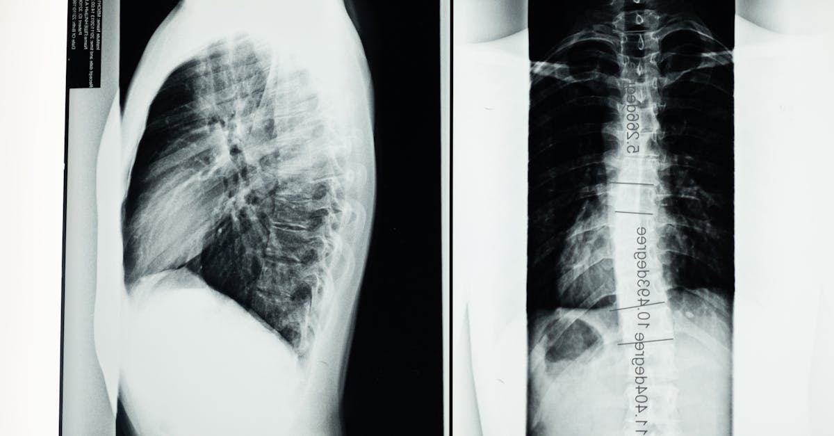 découvrez des informations essentielles sur la scoliose, y compris les causes, les symptômes et les options de traitement. découvrez comment cette maladie de la colonne vertébrale affecte la posture et la santé globale, et explorez des stratégies de gestion efficaces pour vivre avec la scoliose.