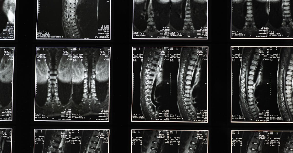 discover essential tips and insights for maintaining optimal spine health. learn about prevention, exercises, and treatments to keep your back strong and pain-free.