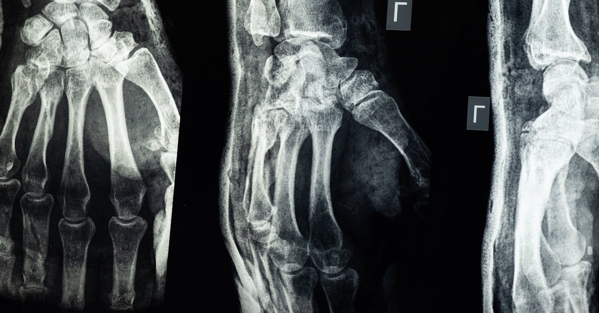 explore the complexities of brachial plexus injuries, their causes, symptoms, and treatment options. understand how these injuries affect arm and shoulder function and the latest advancements in rehabilitation.