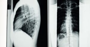 discover what scoliosis is, its causes, symptoms, and treatment options. learn how to manage this spinal condition effectively for a healthier, pain-free life.