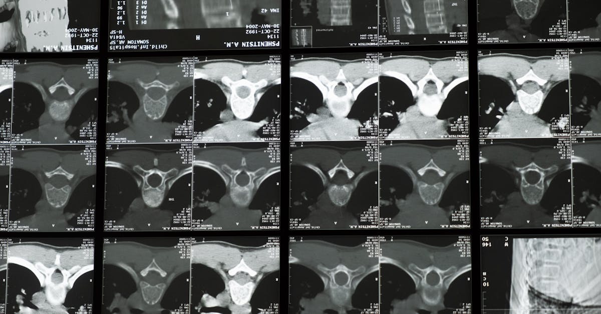 discover essential information about scoliosis, its causes, symptoms, and treatment options. learn how to manage this condition and improve spinal health with expert advice and resources.